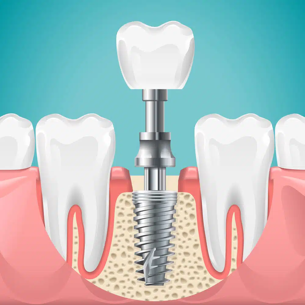 westside dentistry el paso tx home services dental implants