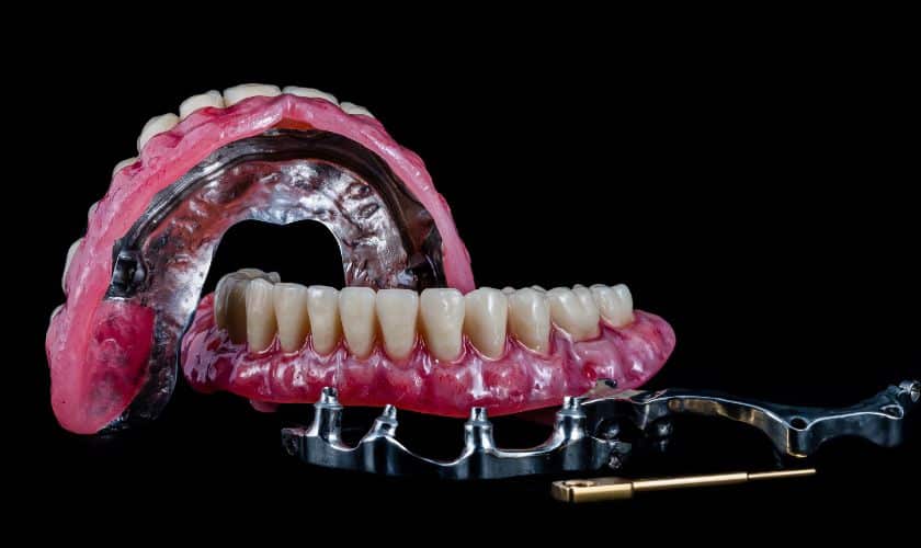 When Are All-On-4 Dental Implants The Best Option